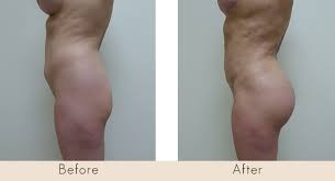 We did not find results for: All You Need To Know About Brazilian Butt Lift Costs In 2019