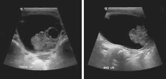 Image result for Urethral Prolapse