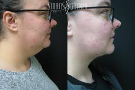 Facial Liposuction for Harrisburg & Lancaster, PA