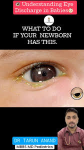 Image result for Eye Discharge