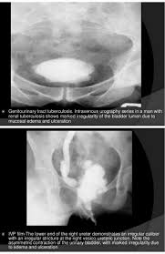 Thimble Bladder Sign Tuberculosis Involvement Of The Bladder May Cause Calcification In The Wall Which May Become Thick And Reduce Th Radiology Bladder Signs