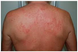 Image result for Papular urticaria