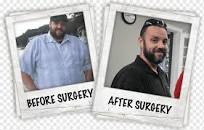 Tom Segura Weight loss Gastric bypass surgery Sleeve ...