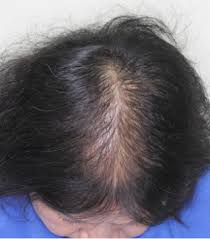 Hair loss and thinning is not so common in asians than in other races. Vertex Accentuation In Female Pattern Hair Loss In Asians Semantic Scholar