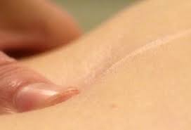 Redonner forme à la poitrine, plus de volume aux seins, rééquilibrer les seins qui diffèrent de par la. La Cicatrisation Post Operatoire Et Le Massage Des Cicatrices