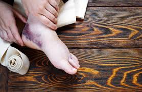 Image result for Ankle Dislocation