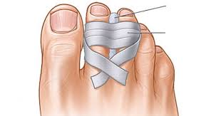 Expert Diyer Shares Genius Shoe Hacks That I Never Heard Of This Can Help Anyone Broken Toe Athletes Foot Remedies Middle Toe