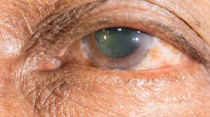 Maybe you would like to learn more about one of these? Cataratas Causa Mas Comun De Perdida De La Vision En Personas Mayores Unam Global