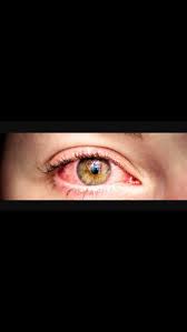 When I Wake Up From A Night Of Sleep My Eyes Are Bloodshot Why Is This Answer Our Eyes Stop Making Tears Red Eye Treatment Bloodshot Eyes Red Eyes Remedy