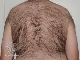 Image result for Hypertrichosis