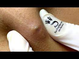 Relax Every Day With Sac Dep Spa 0197 Youtube In 2021 Panel Quilt Patterns Blackheads On Face Whitehead Removal