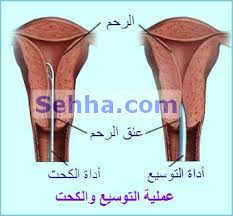 عملية الكحت بالصور