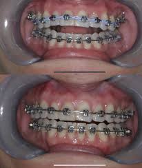 Also, overextending your jaw to chew chips or crusty bread can aggravate your braces pain and also prolong it. Neuromuscular Orthodontics Beverly Hills Ca Fagga Los Angeles Tmj