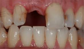 This is a relatively invasive and unpleasant infection that can nevertheless save the tooth by cleaning the infection or removing the decaying portion of pulp. Dental Implants Liverpool 94 M Cost Replace Missing Teeth In 2020