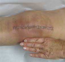 Staples are usually removed 7 to 14 days after they are placed, but this length of time depends on the healing rate, as well as the size and depth of the wound. Joint Surgery Faqs Floyd Health