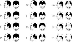 #naturalhair #naturalhairjourney #howtogrowhair #grownaturalhairfasterin this weeks episode we talk about men, hormones and hair loss. Dht How Does It Cause Hereditary Hair Loss Hair Growth Specialist