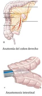 A baseline carcinoembryonic antigen (cea) blood test is obtained. Cirugia En El Cancer De Colon Derecho Anastomosis Intracorporea O Extracorporea Nuestra Tecnica Quirurgica Blogs Quironsalud