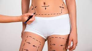 ¿Qué tipos de Lipoescultura y Liposucción existen?