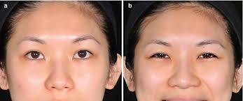 He had bilateral epicanthal folds, a flat nasal bridge, and long eyelashes. The Most Common Indications Plastic Surgery Key