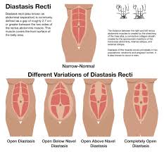 We did not find results for: Diastasis Recti Physiotherapy Treatments In Greenwich London Pelvicare