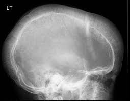 Check spelling or type a new query. Thalassemia Radiology Reference Article Radiopaedia Org