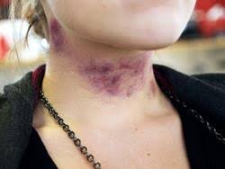 Image result for Strangulation Injury