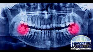 Impacted wisdom teeth are third molars at the back of the mouth that don't have enough room to emerge or develop normally. Common Signs You Need Your Wisdom Teeth Extracted Riccobene Associates Family Dentistry