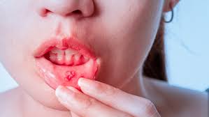 Image result for Mouth ulcers roof of mouth