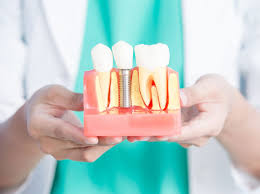 3m fast release varnish coating can be removed by brushing and flossing. Can I Drink Coffee After Dental Implant Surgery Dr Ai Vo
