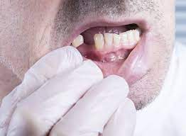 Horizontal bone loss is the most common pattern ol bone loss in periodontal disease. Your Oral Health Options With Bone Loss Angela Evanson Dds In Parker Co Dentist 720 409 0008 80134
