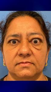 Finished up at a brilliant weekend in San Francisco, talking about the  latest insights into managing Thyroid Eye Disease with some of the most  brilliant minds in the industry. Loved being able