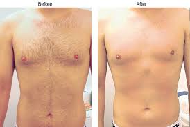 You can also apply a warm, damp washcloth to your nipples for about two to three minutes. Hair Reduction Through Laser Hair Removal In Los Angeles California
