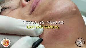 Electrolysis = permanent hair removal. Electrolysis Video 26 Gray Hair Removal Youtube