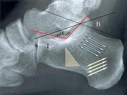 Image result for Calcaneus Compression Fracture