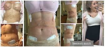 Pin On Breast Surgery