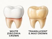 Zirconia and Emax Crowns product image