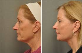 Pin On Changes Before And After Plastic Surgery