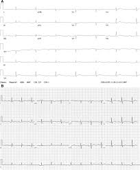 Image result for Lyme Carditis