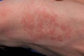 This could be due to an allergic reaction to some unknown substance or secondary to insect bite etc or due to heat rash. Skin Rashes In Children Nidirect
