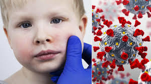 Image result for vyrážka u dětí