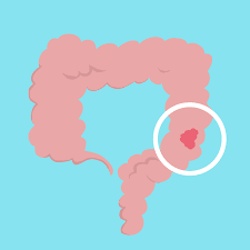 Signs and symptoms of bowel cancer. Colon Cancer Overview And More