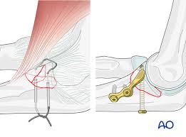 Image result for Coronoid Process Fracture