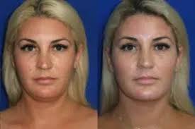 Neck Lift In Newport Beach, CA