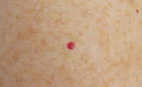 What is a cherry angioma? Cherry Angioma Removal Skin Surgery Clinic