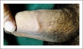 Patients usually present with a painful breast. Atypical Penile Mondor S Disease Involvement Of The Circumflex Vein Semantic Scholar
