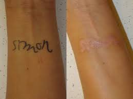 Our senior consultant maelle answer your questions about pain, amount of treatments and after care. Dr Joel Schlessinger Shares The Latest Laser Treatments For Tattoo Removal Dr Joel Schlessinger