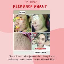 Ambil layer pertama kulit pisang tu dan apply dekat tempat parut selama 15min atau sehingga kering. Tips Rawatan Parut Berlubang Tanpa Laser T9 Skincare