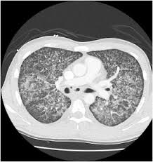 Survey of german ards centers and scientific l. Ards From Miliary Tuberculosis Successfully Treated With Ecmo Sciencedirect