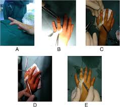 With mallet finger, the tendon on the back of the finger (not the palm side) is separated from the muscles it connects. Scar Overlapping Suture For Treating Chronic Tendinous Mallet Finger In Children Journal Of Orthopaedic Surgery And Research Full Text