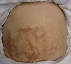 Find facts and statistics for reporting about skin cancer. Erythema Ab Igne Wikipedia